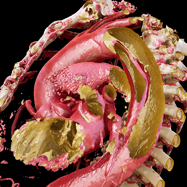 Viewtify Aortic Dissection